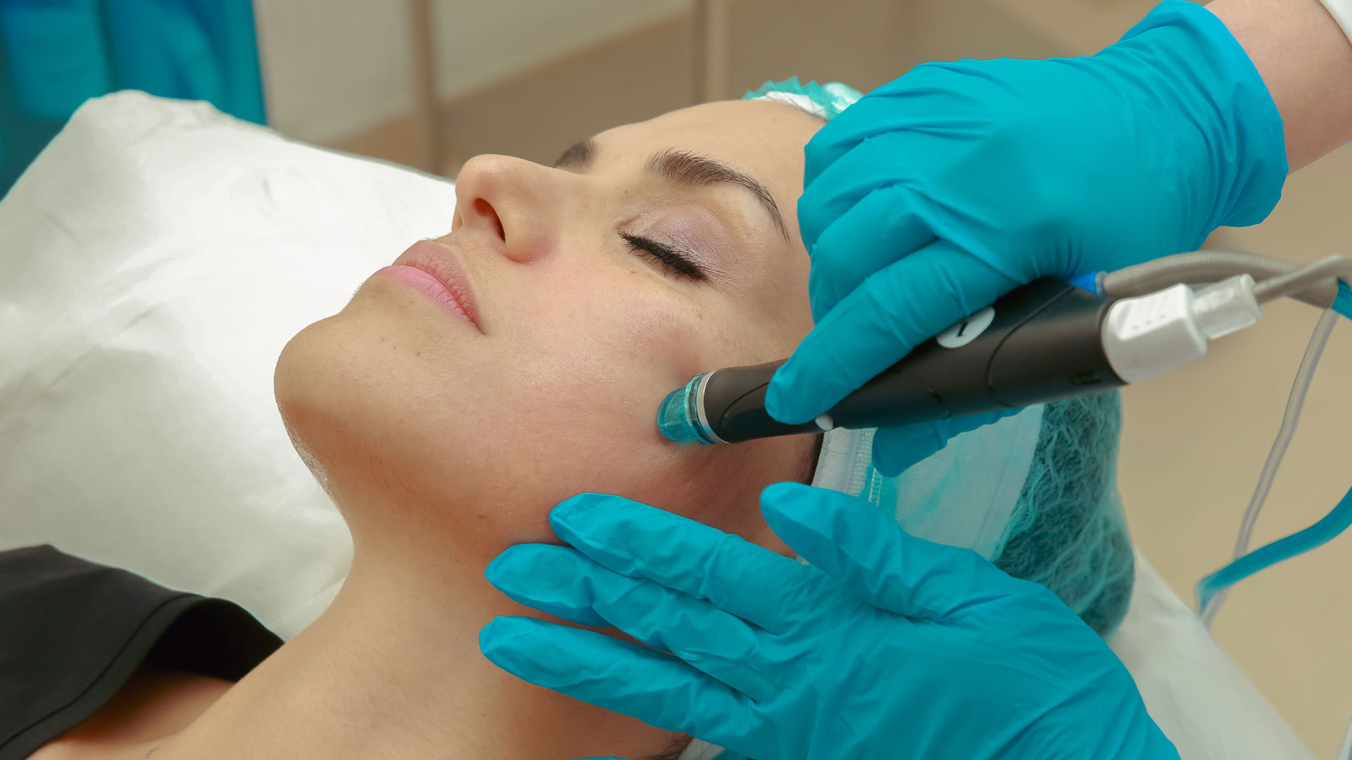 Needling viso Brescia | Dott. Riboldi Needling viso Brescia | Dott. Riboldi